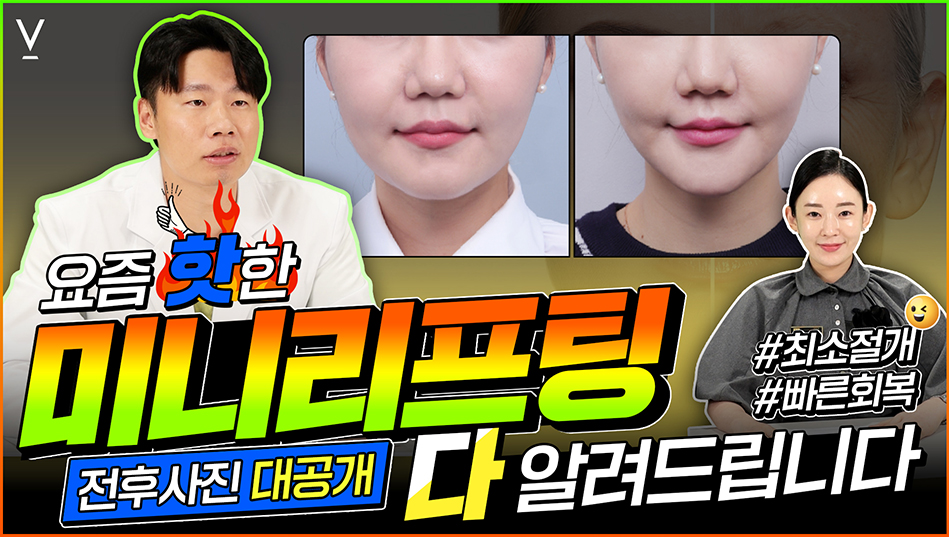 미니리프팅 전후