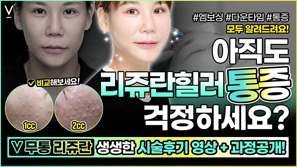 v무통리쥬란 시술후기