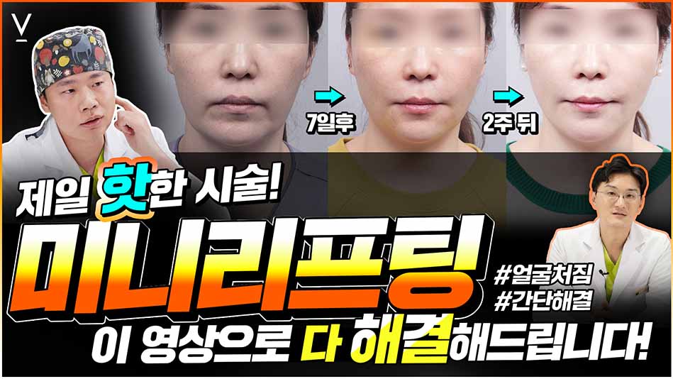 미니리프팅 시술