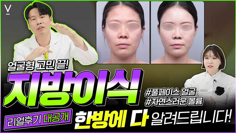 지방이식 리얼후기