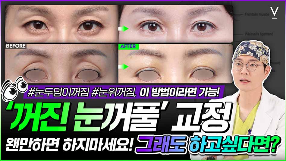 꺼진 눈꺼풀 교정
