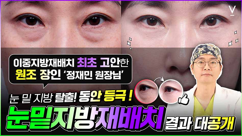 눈밑지방재배치 결과