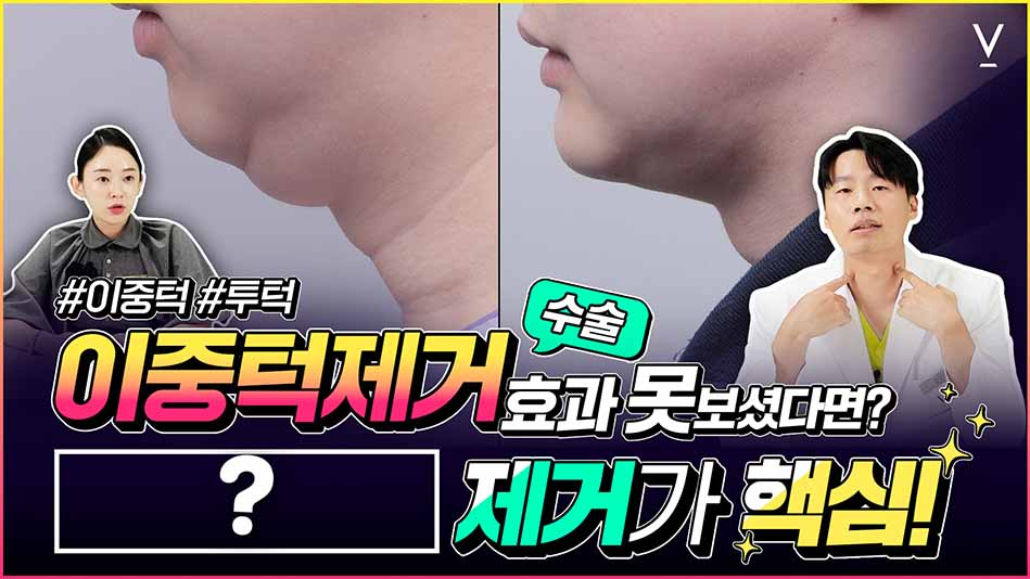 이중턱제거 핵심