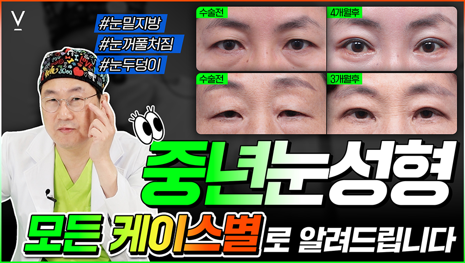 중년눈성형