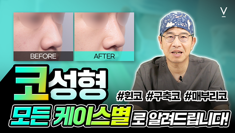 코성형