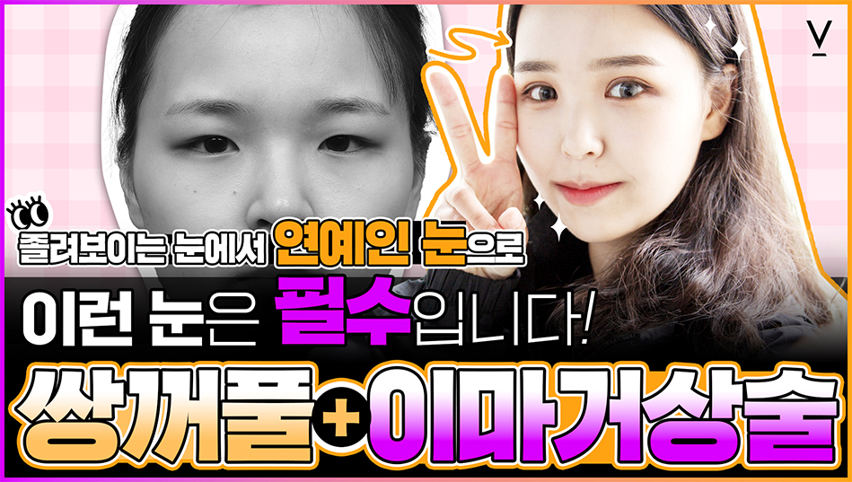 쌍커풀+이마거상술