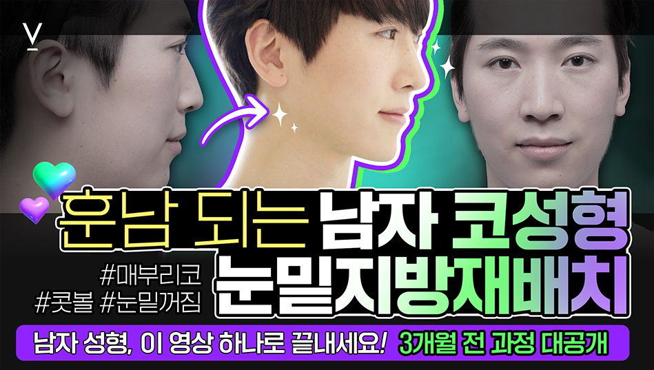 눈밑지방재배치